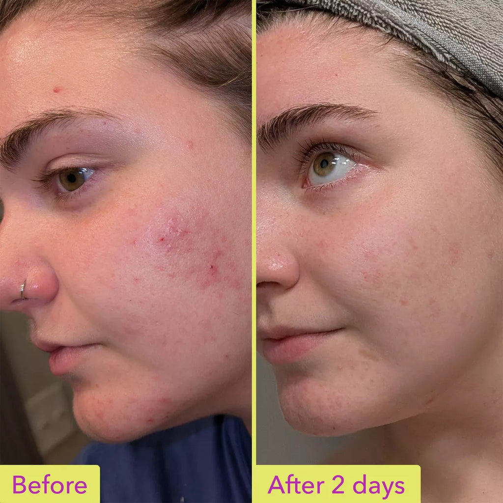 Good Molecules 10% Azelaic Acid Face Treatment - 30Ml: Skin Tone Improvement, Unscented, Liquid Form